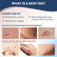 Advanced Skin Tag Remover - FDA-Cleared Device - Only for Skin Tag Removal - Works in 7-14 Days - Up to 10 Treatment Cycles - Cryogenic Freeze-Off Kit